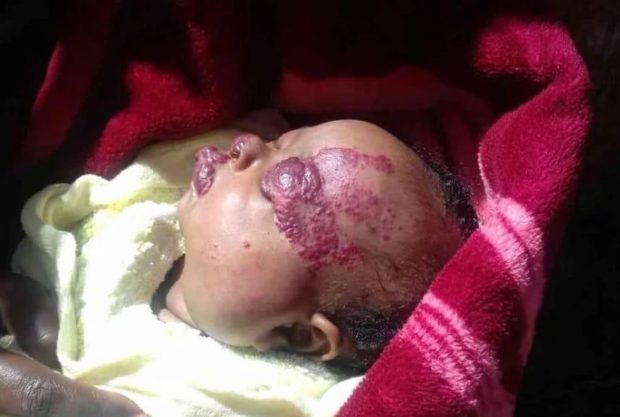 Two month old baby suffering from a strange disease item-thumbnail